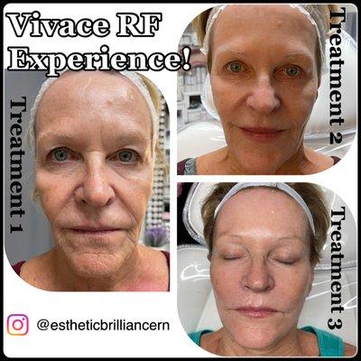 WOW! A three series of Vivace RF microneedling treatments paired with AnteAgeMD Serum & Accellerator. Amazing results!