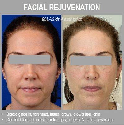 Total facial rejuvenation: neuromodulators and dermal fillers were used on the entire face