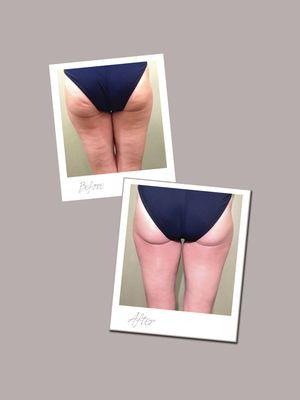 Emsculpt and Lymphatic drainage Before and After