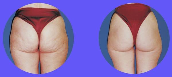 Cellulite reduction by LPG Endermologie
Before and after.