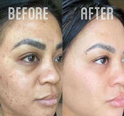 Vi Peel Precision Plus for dark spots, fine lines and scars