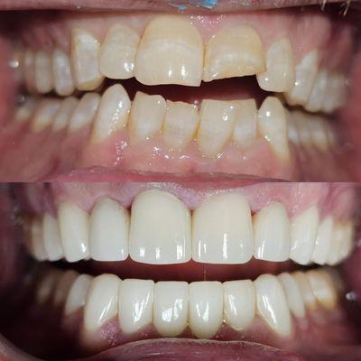 Smile makeover