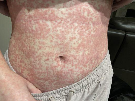 Rash from bad diagnosis