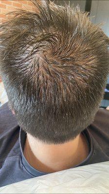 Hair restoration with PRP