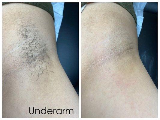 Before and after waxed underarm