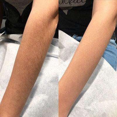 Before & After full arm wax