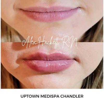 Lip Filler