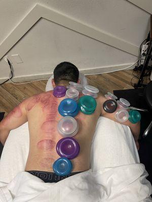 Cupping