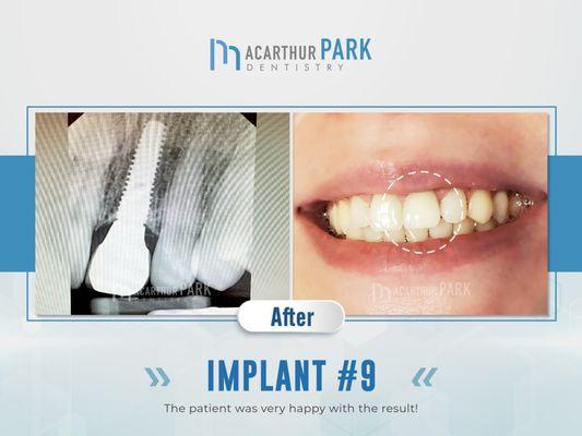 MacArthur Park Dentistry Emergency, Invisalign, Implant | Call: (972)831-9600