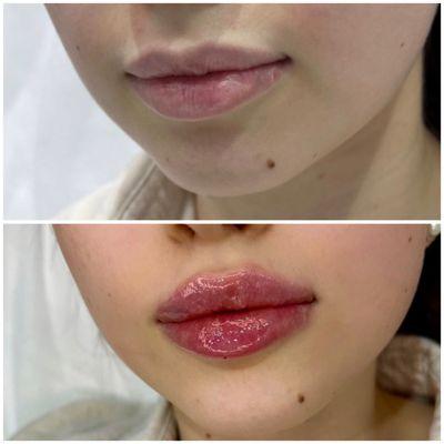 Lip filler 1 ml injection before and after