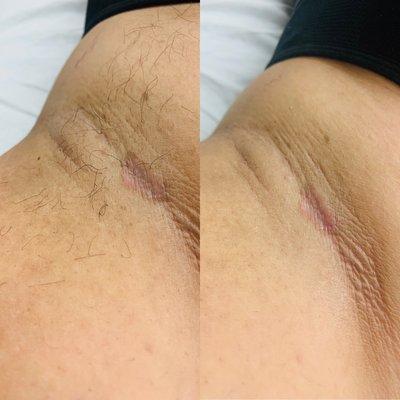 Maintenance underarm sugaring