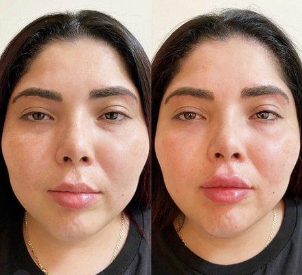 Lip augmentation