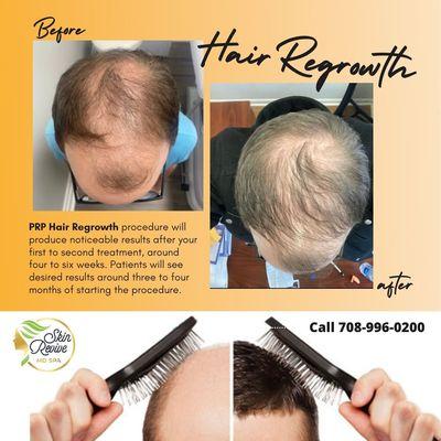 PRP Hair Growth (Platelet-rich plasma) is a non-invasive procedure utilizing your blood plasma to rejuvenate hair growth in areas that have