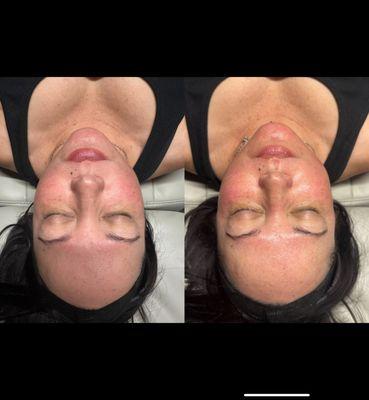 Before/After Hollywood Peel with Dermaplane Add-On