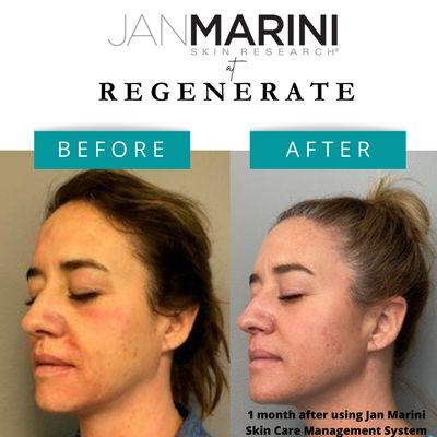 1 month after using Jan Marini Skin Care Management System!