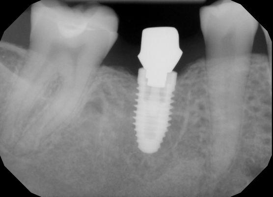 Dental implant