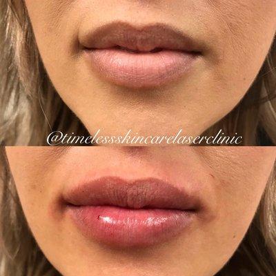 Lip Augmentation Before + After