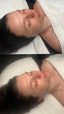 Before and after a 90 minute DermaPlane Custom Facial