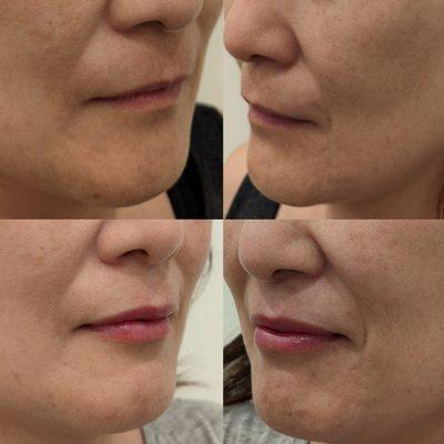 Before & After - Side view of lip filler