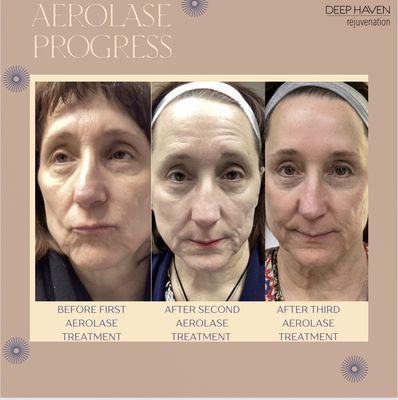 Aerolase Neo Elite Laser after 3 treatments