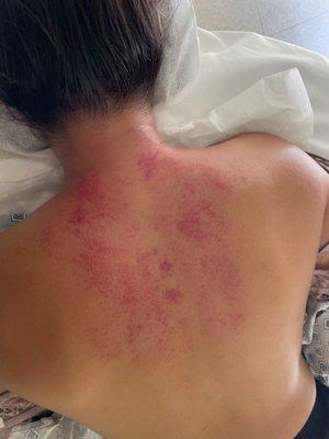 After Gua sha session (jade stone massage). The redder the spots, the more of an imbalance there was.