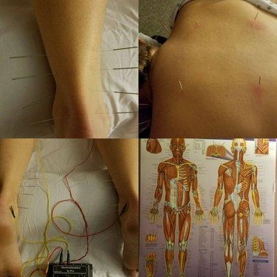 Electric-Stim Acupuncture