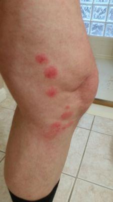 bed bug bites