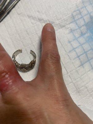 I had an accident and my ring had to be cut off at the hospital.  I was very sad