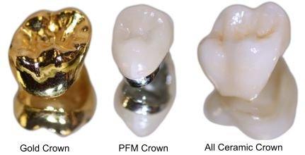 Dental Crowns