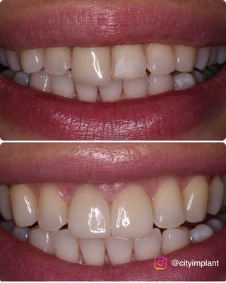 Just one crown and one veneer to totally change the complexion of our patient's smile.  Case by Dr. Christopher Rong.