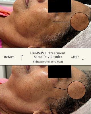 1 BioRePeel Treatment Before & After