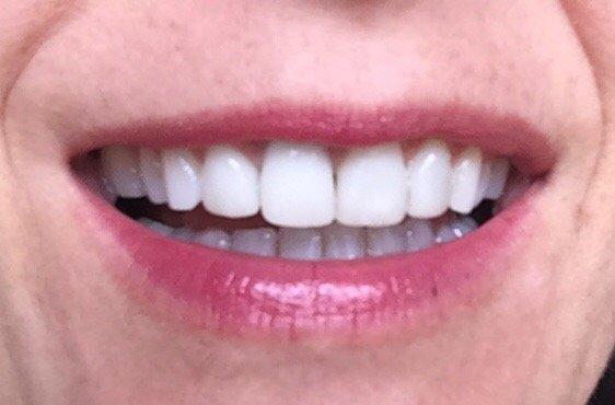 veneers on 4 front teeth