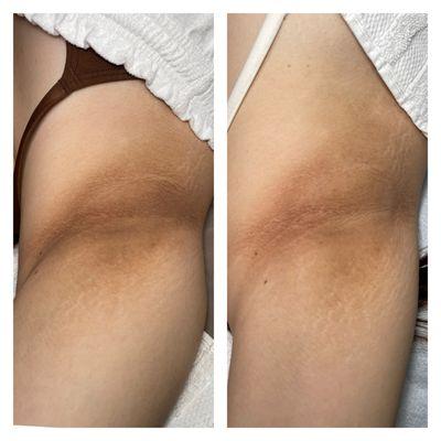 Another Underarm Brightening Treatment (after one session) after photos taken before doing the 2nd session treatment.