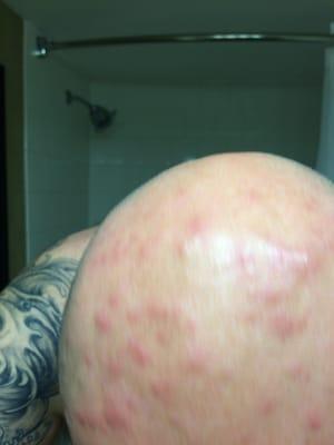 This is what my head looks like after being infested by bedbugs in this piss hole hotel.