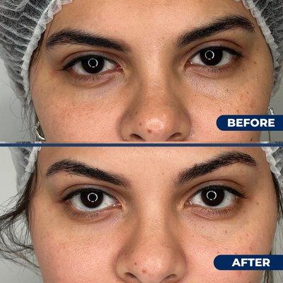 Before & After 
dark circles treatment