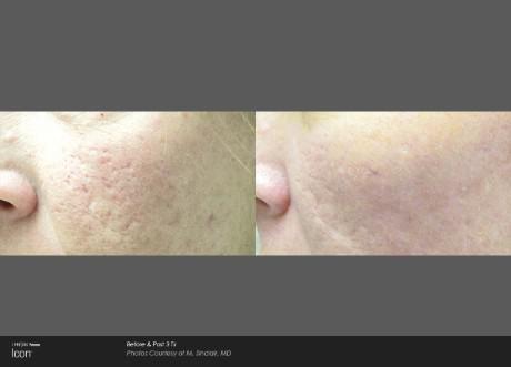 Acne Scar Removal