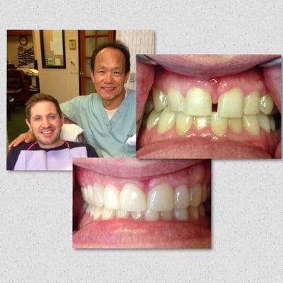 James with his new beautiful Lumineers, after closing his large front gap. Keeping his teeth in proportion was the key to success.