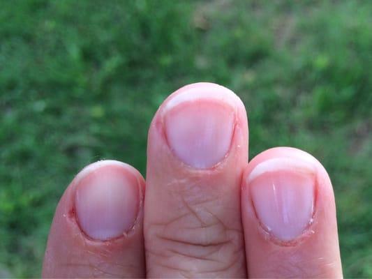 Nails right after she cut into my skin.