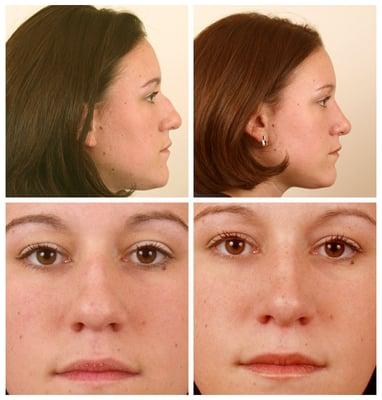 Rhinoplasty at Louis William Apostolakis M.D., Facial Plastic Surgery, Westlake Hills, TX