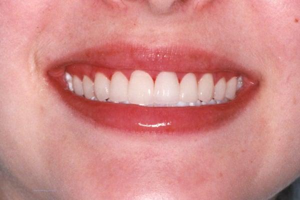 AFTER: A beautiful new smile is revealed with porcelain veneers.