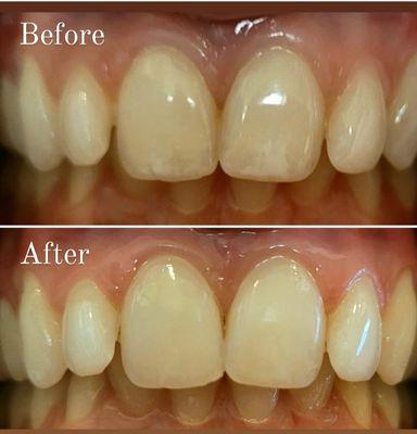 Reduce the visibility of white spots on your teeth. . Ask us how.