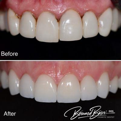 Smile makeover with porcelain veneers. Only two visits.