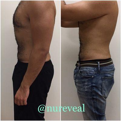 Improvement in abdominal contour 8 weeks after one fat freezing treatment.