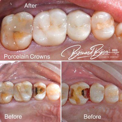 Porcelain crown treatment for old dental fillings with cavities.