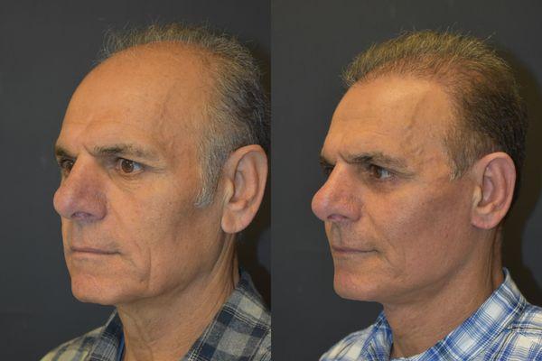 L&P Signature Facelift on Los Gatos man