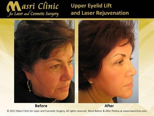 After upper and lower eyelid surgery (blepharoplasty), skin treatment and CO2 Laser Skin Resurfacing, she has lost years in age!