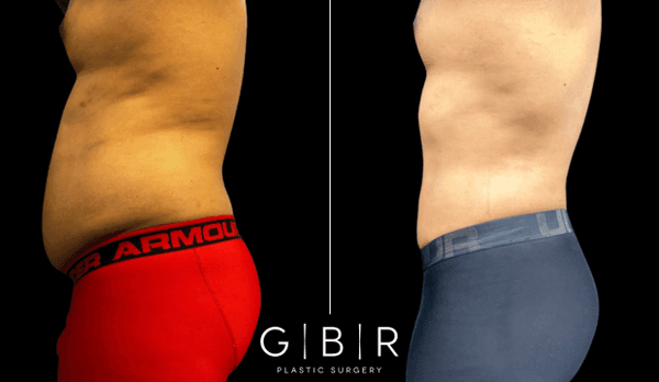 Male Liposuction by Galardi Bowen Plastic Surgery