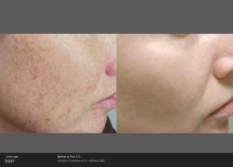 Icon laser treatment results