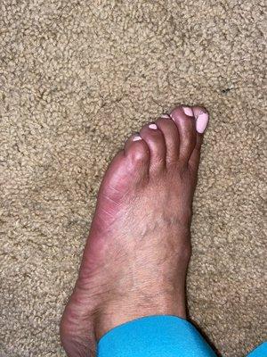 My left foot around 7:30 pm 5/29/24