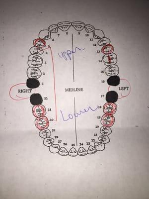 Everywhere circled red was supposedly where I "needed" crowns on my teeth.